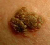 seborrheic keratosis